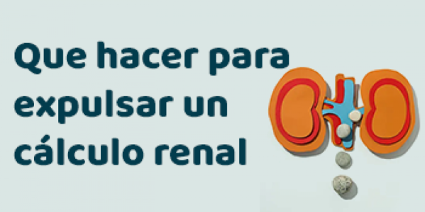 Que hacer para expulsar un cálculo renal