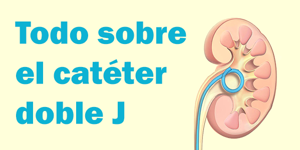 Todo sobre el catéter doble J