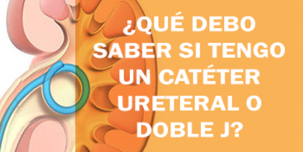 ¿Qué debo saber si tengo un catéter ureteral o doble J?