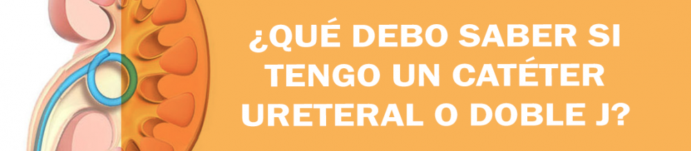 ¿Qué debo saber si tengo un catéter ureteral o doble J?